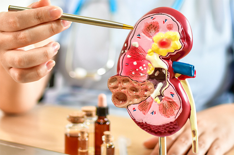 Penyakit Ginjal Kronis