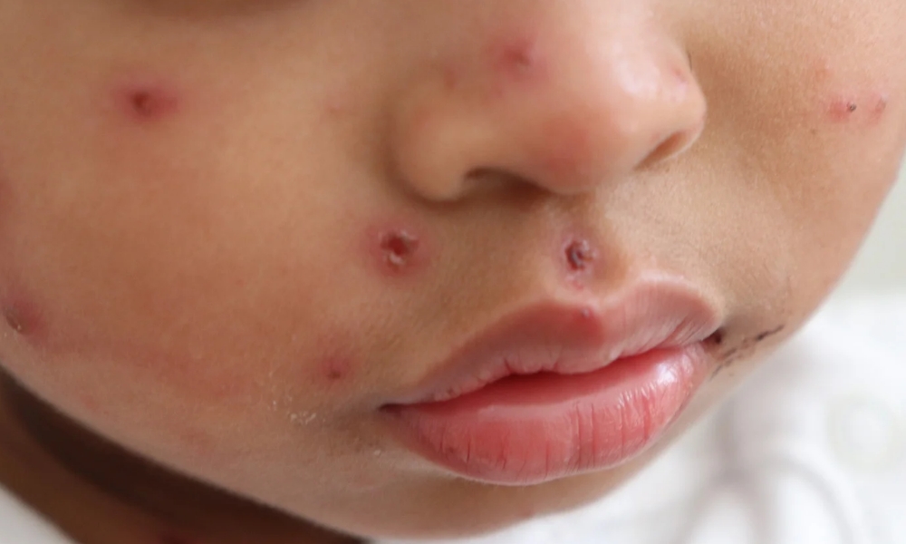 Rentan Tertular Campak