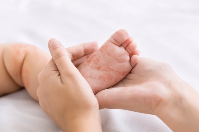 Rentan Tertular Campak