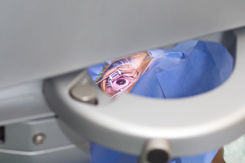 Tantangan Sebelum Menjalani Lasik Mata
